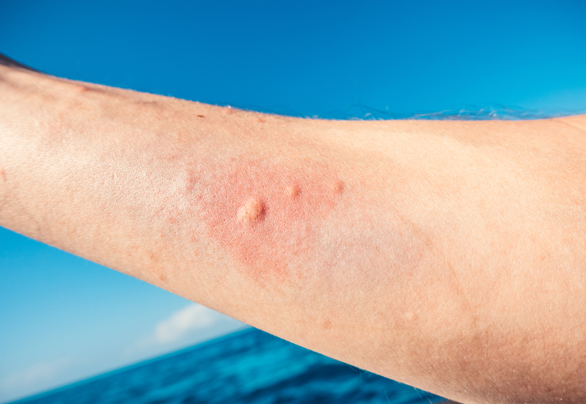 Jellyfish Sting