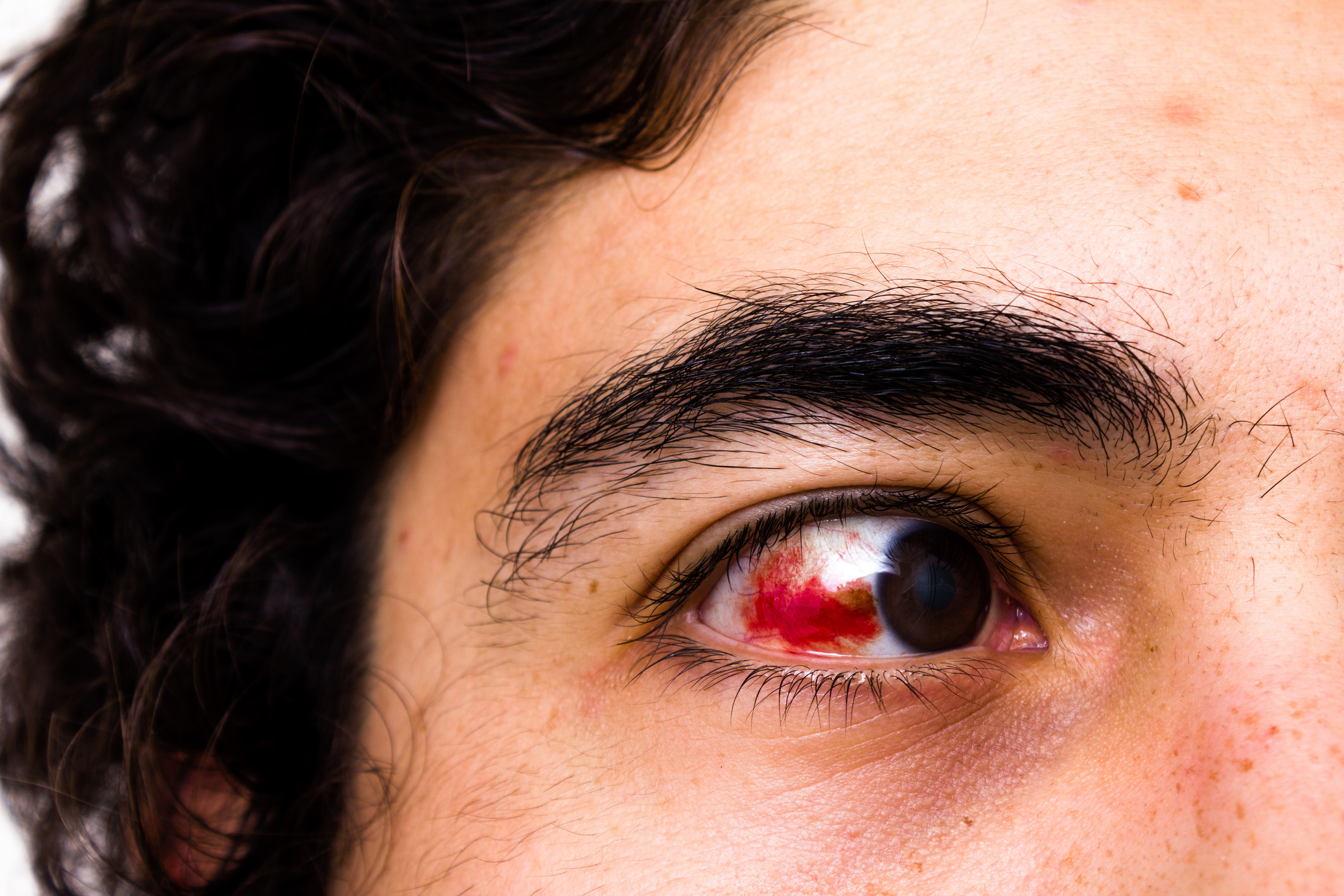 Eye Injury