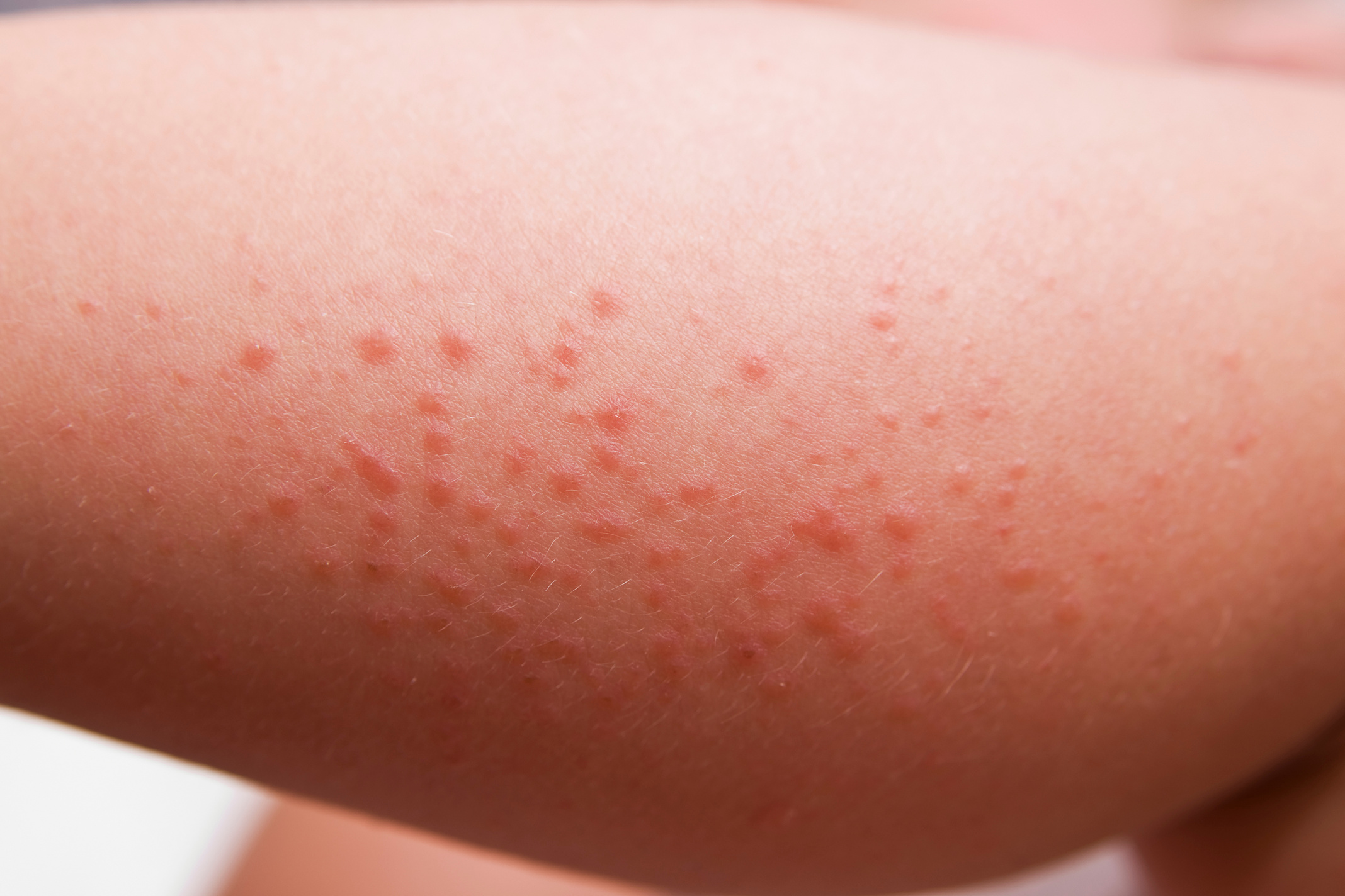 Rash