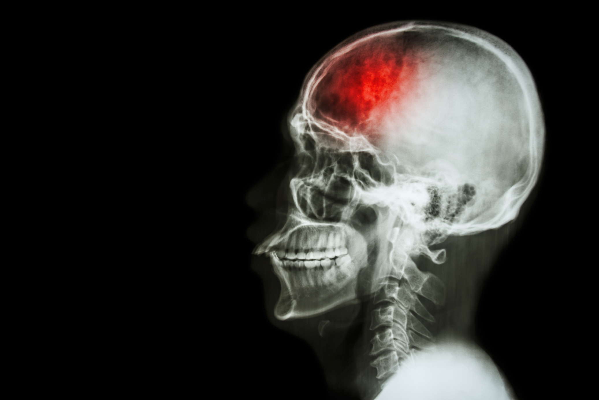 'Stroke' (cerebrovascular accident)
