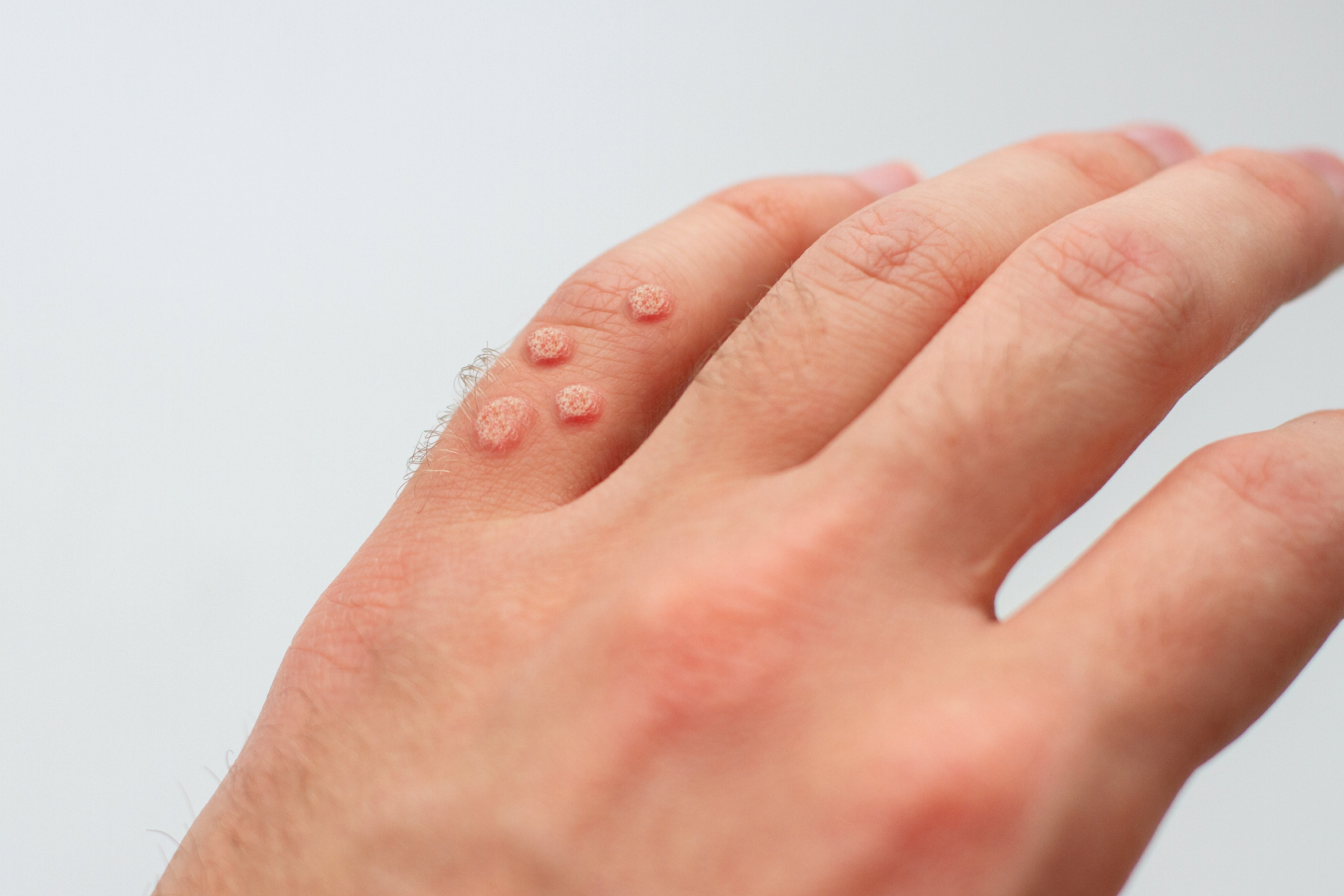 Finger with warts. Viral warts on hand