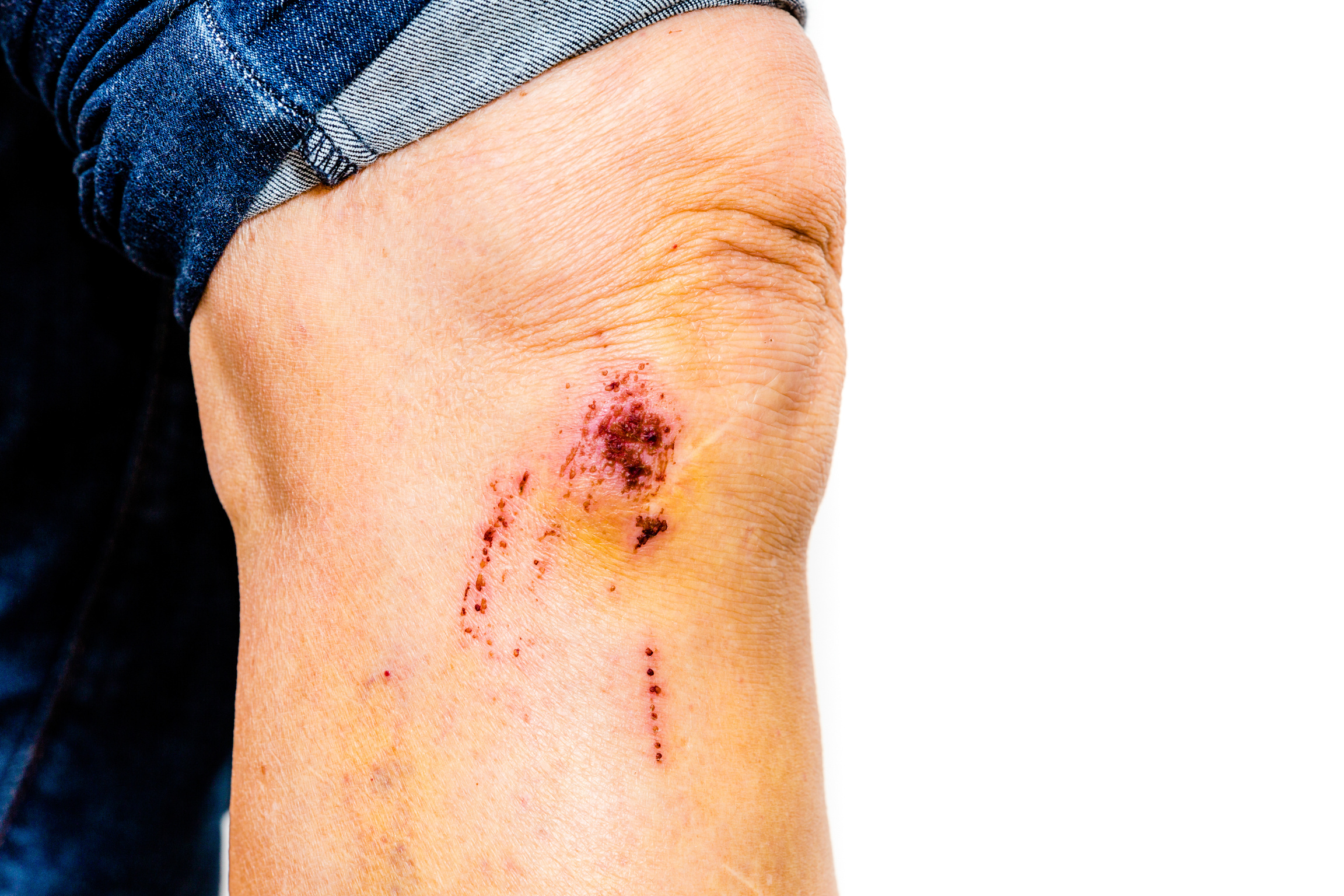 abrasion