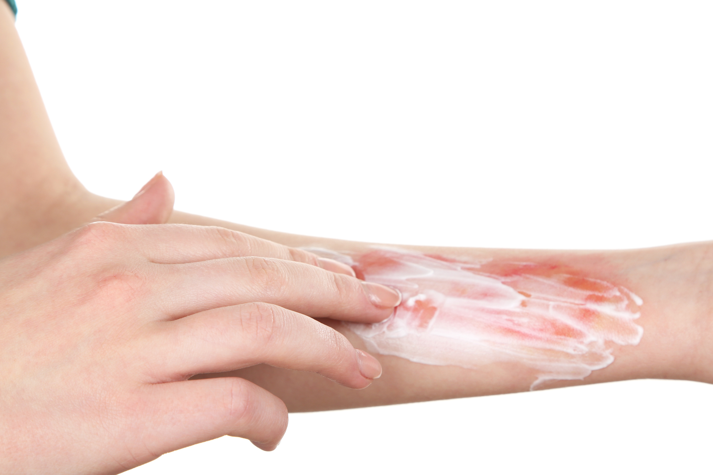 Female Applying Ointment on her Burn Injury