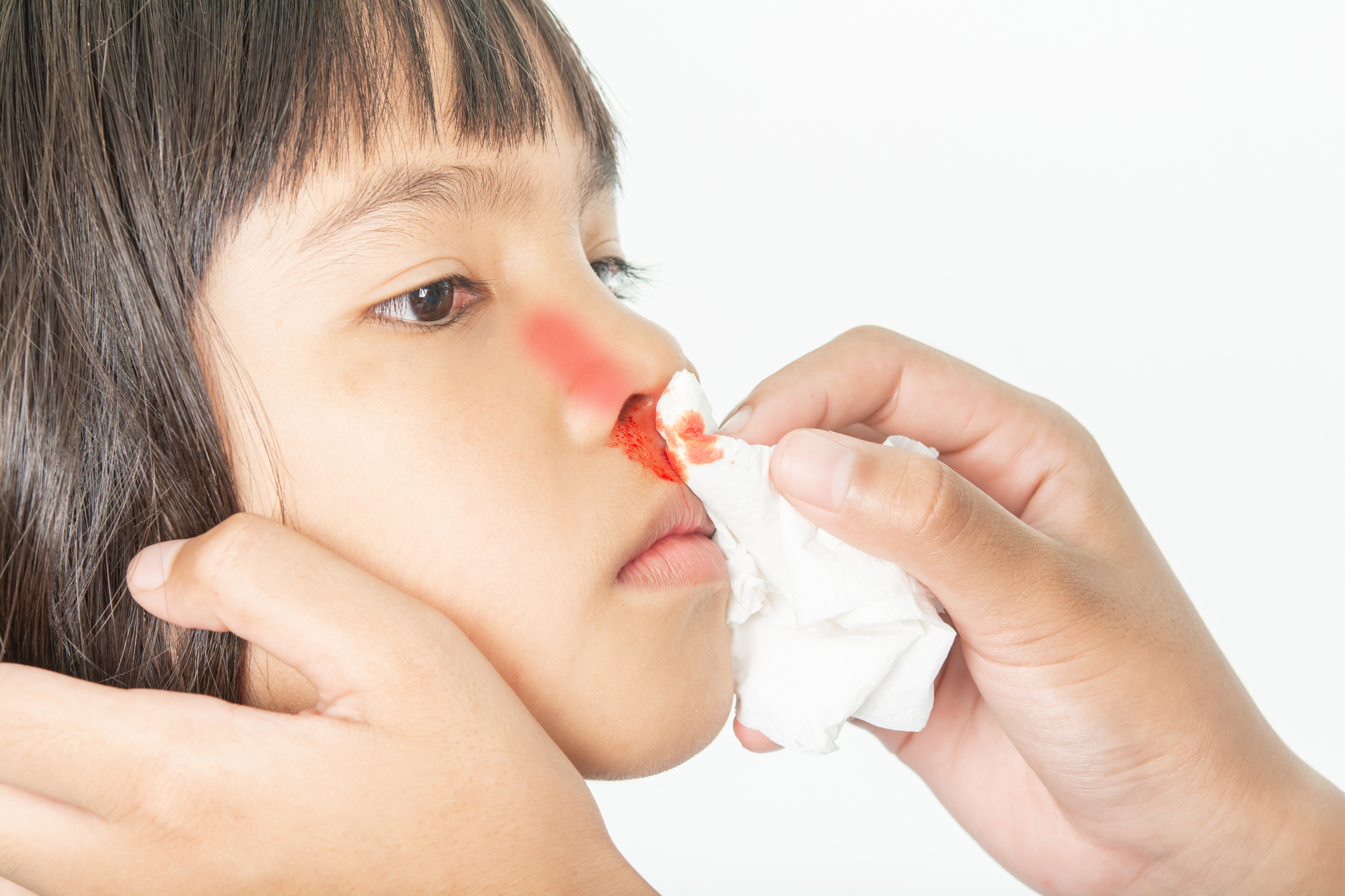 Bleeding in the nose