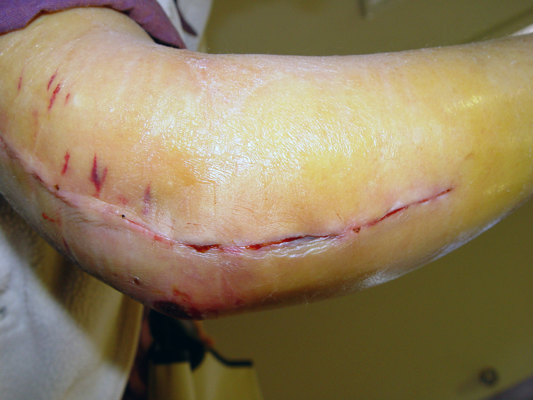 Post-operative elbow replacement