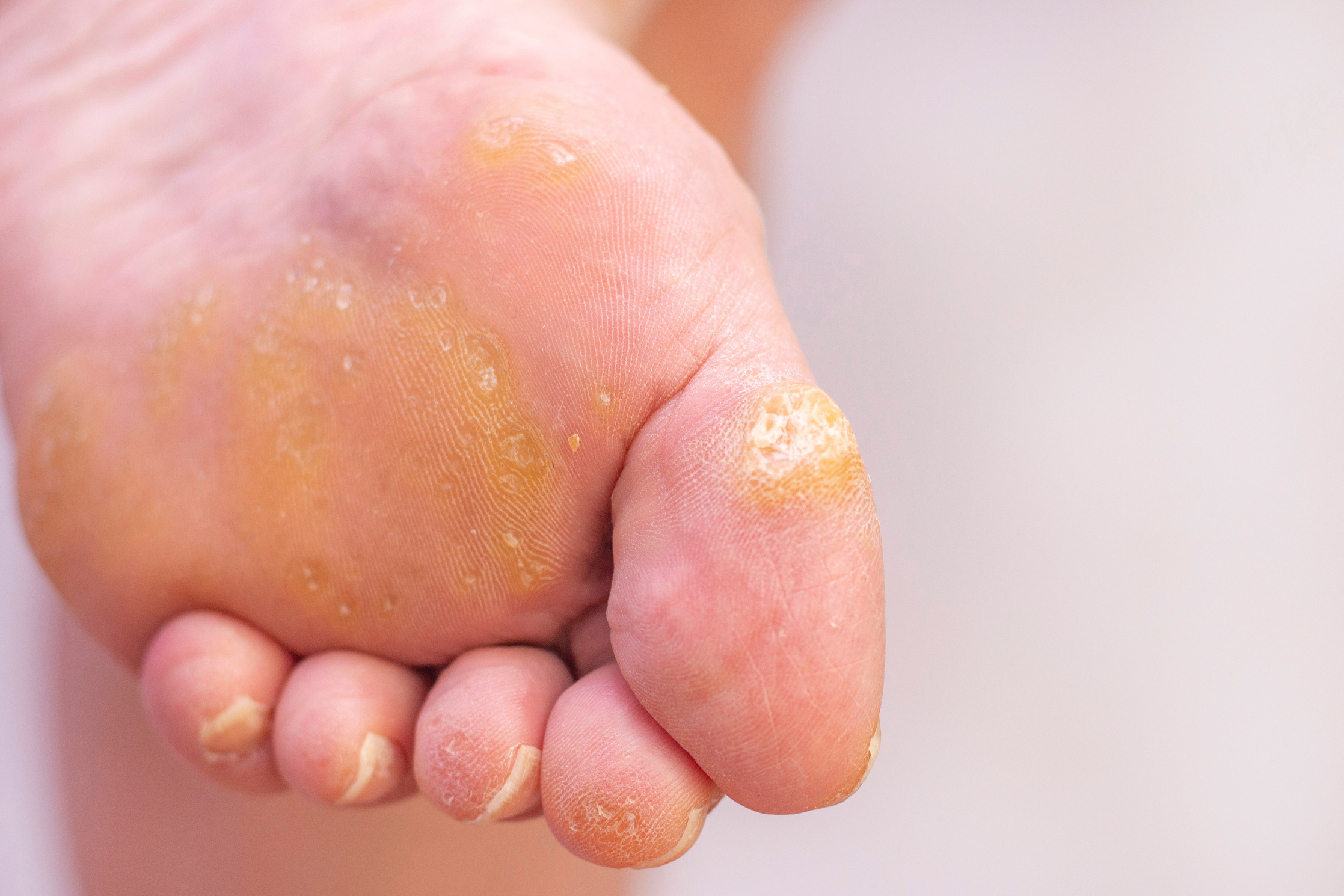 Warts and corns on a womans foot. dermatology disease. plantar warts. at the appointment with a dermatologist. female foot with warts on a light background.