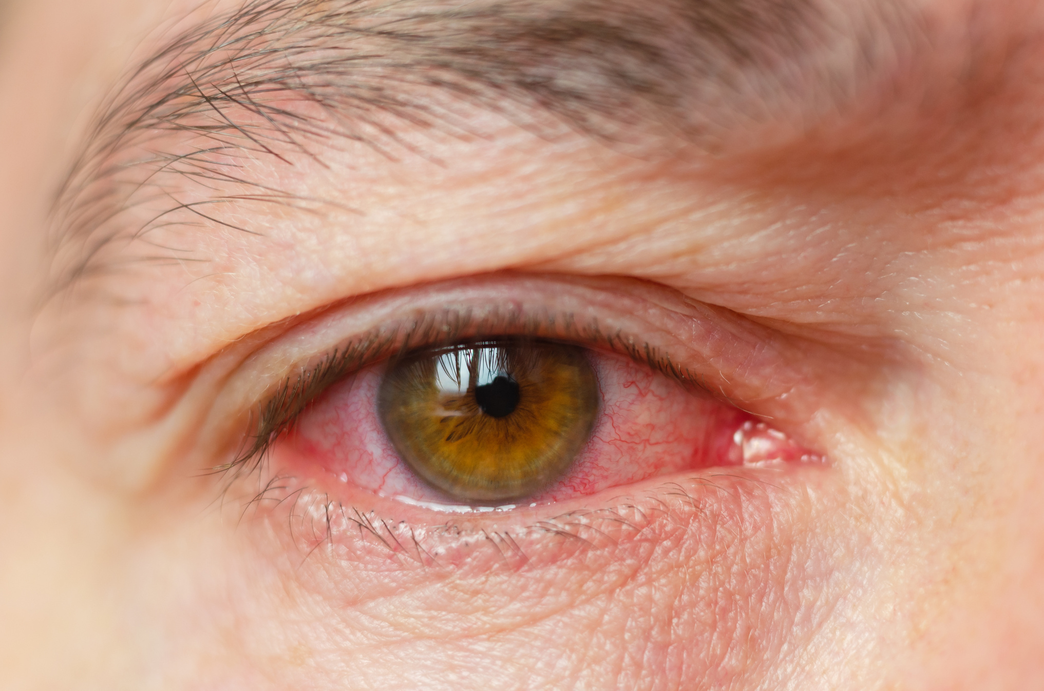 Closeup irritated infected red bloodshot eyes, conjunctivitis